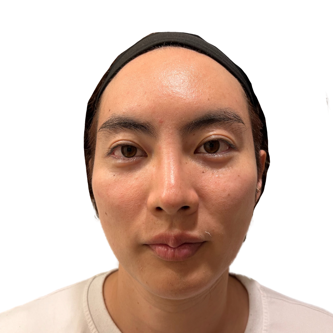 マヌカフェイシャル（ダーマペン4）